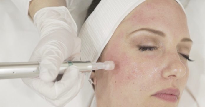 microneedling-test